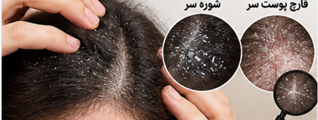 شوره سر، خشکی پوست سر یا قارچ پوستی؟ تفاوتها، علت هاو روشهای مراقبت