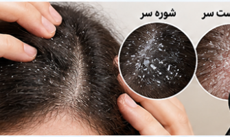 شوره سر، خشکی پوست سر یا قارچ پوستی؟ تفاوتها، علت هاو روشهای مراقبت